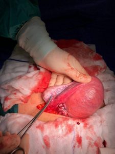 Unikornuat Uterus Ne